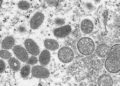Manila posts first mpox case amid global crisis